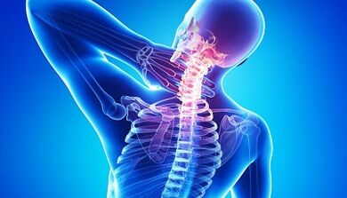 Komplikacije osteohondroze grlića maternice