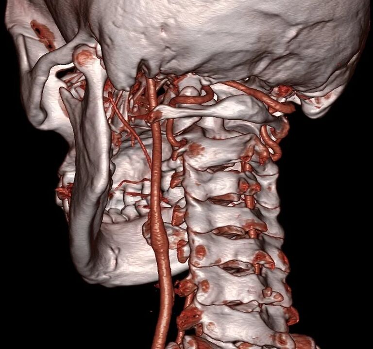 stegnuta arterija s cervikalnom osteohondrozom