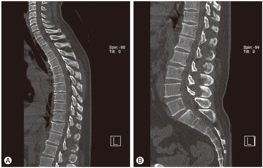 Deformacija intervertebralnih diskova na MRI slikama u torakalnoj osteohondrozi