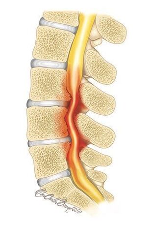 Kod osteohondroze torakalne kralježnice dolazi do kompresije spinalnog kanala