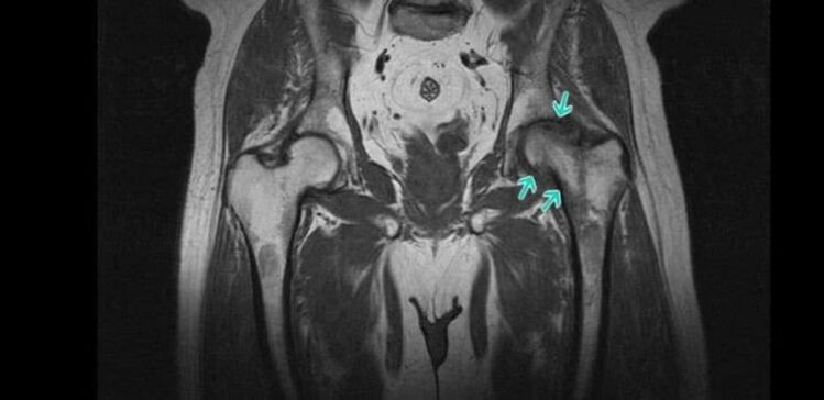 Osteoartritis zgloba kuka na MRI