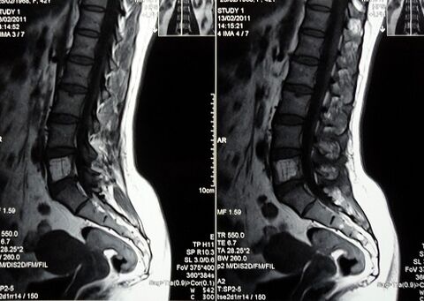 MRI lumbosakralne kralježnice za dijagnosticiranje križobolje